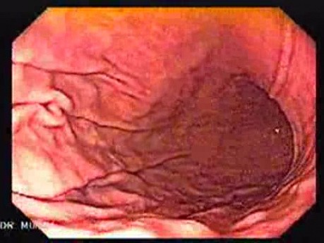 High Resolution Video Endoscopy with Zoom - Gastric Folds