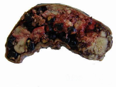 Gallbladder Adenocarcinoma and litiasis (6 of 13)