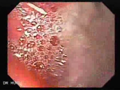 Scirrhous Gastric Carcinoma - Endoscopy (10 of 47)