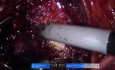 Performing A Retzius-Sparing Prostatectomy with a New Robot