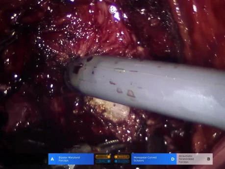 Performing A Retzius-Sparing Prostatectomy with a New Robot