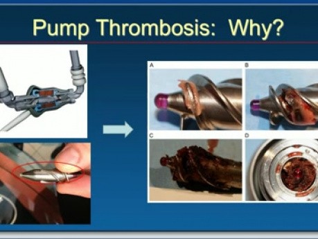 VAD Thrombosis: "A riddle wrapped in a mystery inside an enigma" - Part 2