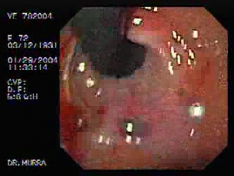Mallory-Weiss Syndrome - Slight Bleeding Around Blood Clot