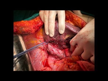 Right Hemihepatectomy En-block With Caudate Lobectomy (And Partial Extension To IVb) For Klatskin Tumor Bismuth 3a