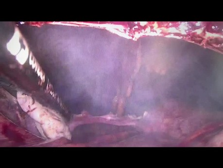 Rotational Maneuver of Uterus for Easygoing vNOTES Salpingectomy