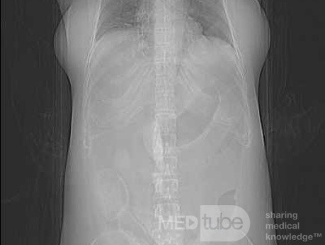 Multiple Rectal Ulcers (38 of 110)