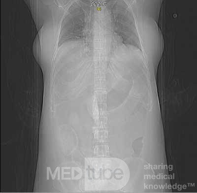 Multiple Rectal Ulcers (38 of 110)