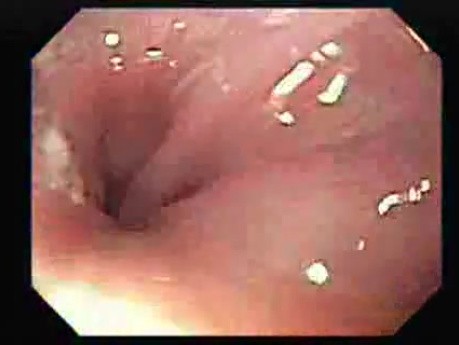 Achalasia Residual Food (1 of 11)