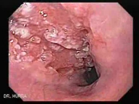 Esophageal Squamous Cell Carcinoma - 75 Year-Old Female with Progressive Dysphagia