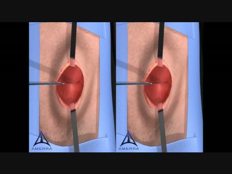 Open Hernia Procedure - 3D Stereographic Animation