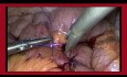 Laparoscopic Suturing Intracorporeal Technique