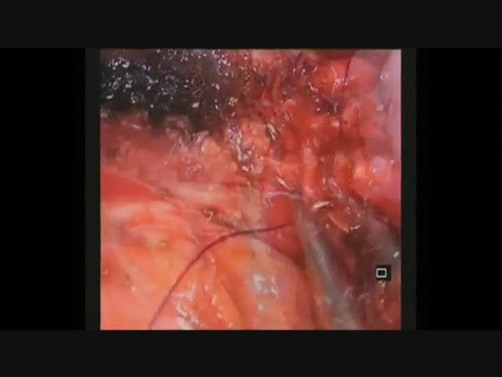 Uniportal VATS Complex Segmental Bronchoplastic Reconstruction after Bilobectomy