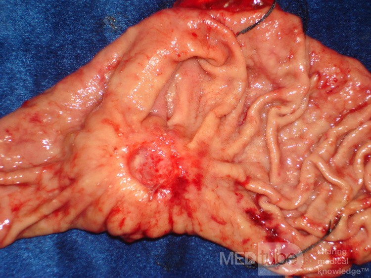 Diffuse Adenocarcinoma with signet ring cells (12 of 18)
