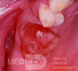 Antral Mucosal Prolapse Through a Tooth Socket