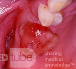 Antral Mucosal Prolapse Through a Tooth Socket