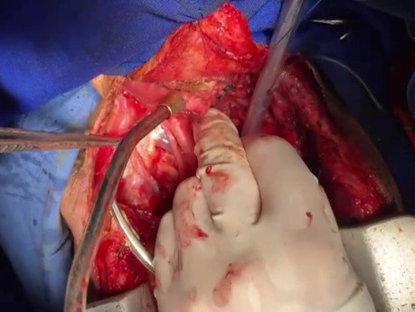 Extensive Laryngeal Tumor Excision and Proximal Stump Closure As Well As Distal Stump Maturation In Suprasternsl Notch