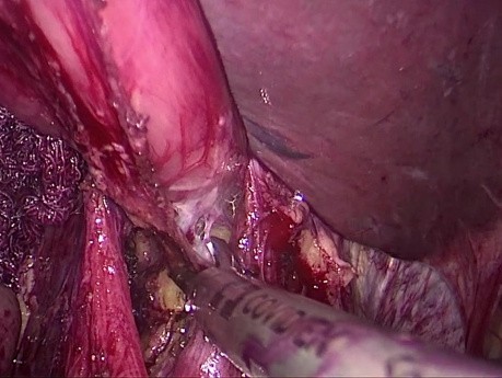 Types of laparoscopic esophagojejunal anastomosis