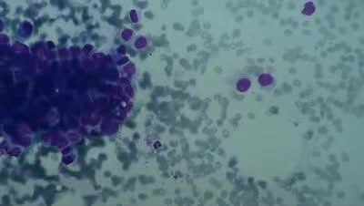Bone marrow -  Metastases