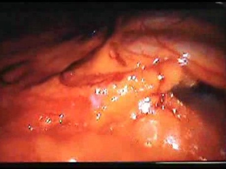 Jejunal Gastrointestinal Stromal tumor (GIST) (17 of 86)