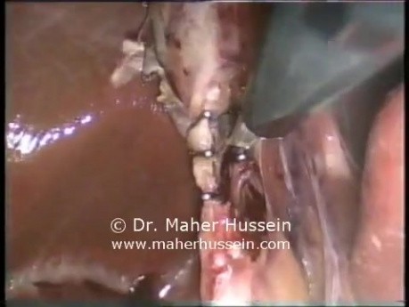 Transumbilical Cholecystomy - Laparoscopy