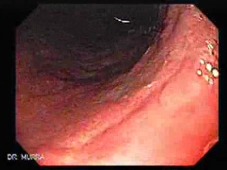 Chronic Gastritis (2 of 8)