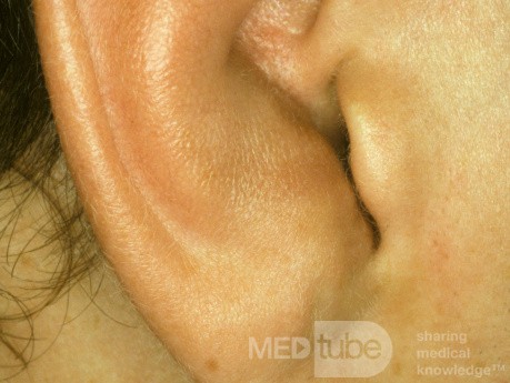 Small Hematoma of the Pinna Before Drainage