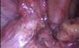 Bilateral Tubectomy, Adhesiolysis