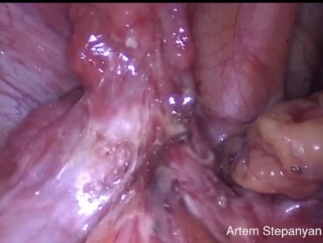 Bilateral Tubectomy, Adhesiolysis