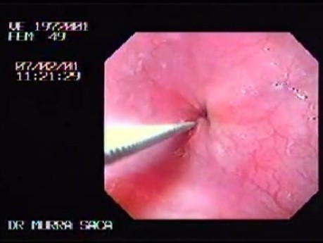 Esophageal Achalasia (5 of 7)