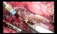 Total Laparoscopic Frey with Roux Y Reconstruction