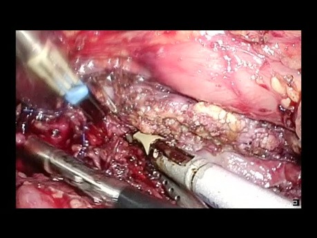 Total Laparoscopic Frey with Roux Y Reconstruction