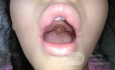 Uvula Hinchada