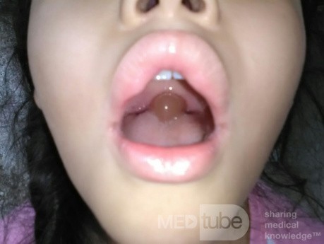 Uvula Hinchada