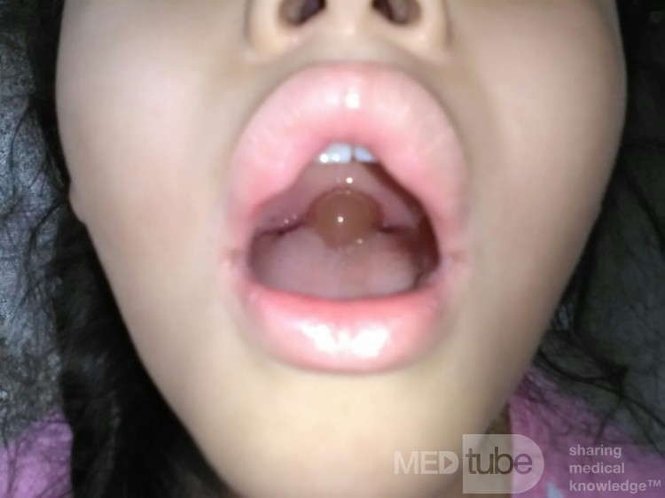 Uvula Hinchada