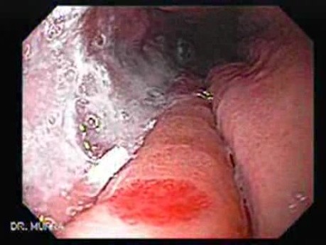 Esophageal Varix - Bleeding - Two Teleangiectasias