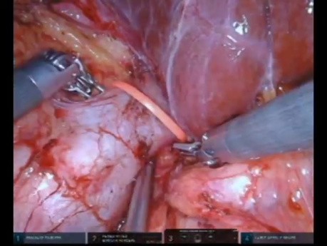 Robot  Assisted Right Radical Nephrectomy With Level II Inferior Vena Cava Tumor Thrombectomy