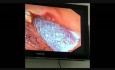 ERCP and Metal Stenting in Hillar Cholangiocarcinoma