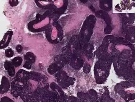 Eye retinoblastoma - histopathology