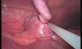 Appendicectomy - SILS 