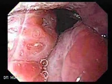 Enlarged Tonsils (2 of 2)