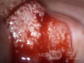 Cervical adenocarcinoma (carcinoma glandulare colli uteri)
