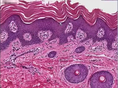 Lamellar ichthyosis