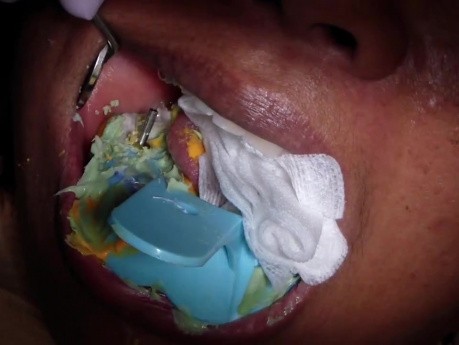 Dental Implant - Open Tray Impression Technique - Removal