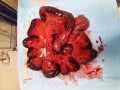 Mesenterial Venous Thrombosis