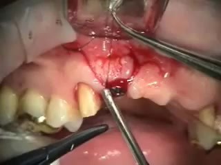 Anterior 3.0/2 Piece Implant Bridge