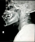 Spinal cord injury from spearfishing harpoon