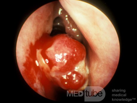 Pyogenic Granuloma