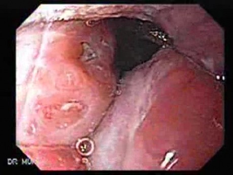 Enlarged tonsils - endoscopic view 2/2, chronic tonsilitis