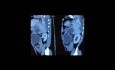 Laparoscopic Cystogastrostomy for Pseudocyst Pancreas 