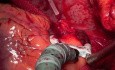 Full Arterial Off Pump Coronary Artery Bypass Grafting - 48 y.o. Male Patient
